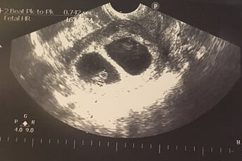 生產記 - 超聲波照片