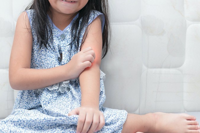 紅疹:濕疹多數出現於5歲以下的兒童身上。