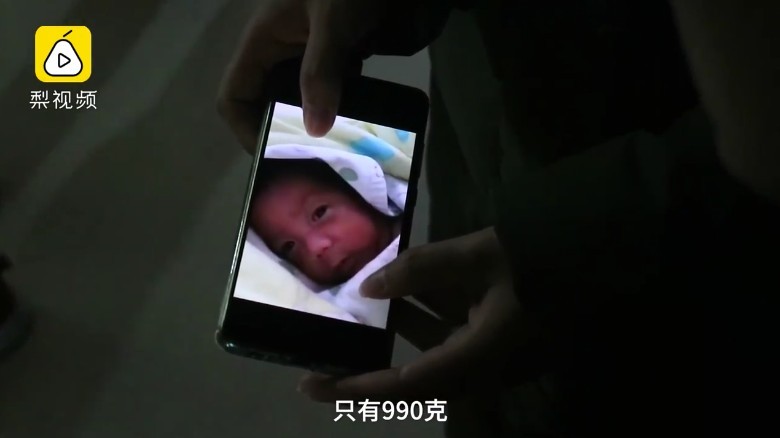早產:出生時體重特別低,只有990克