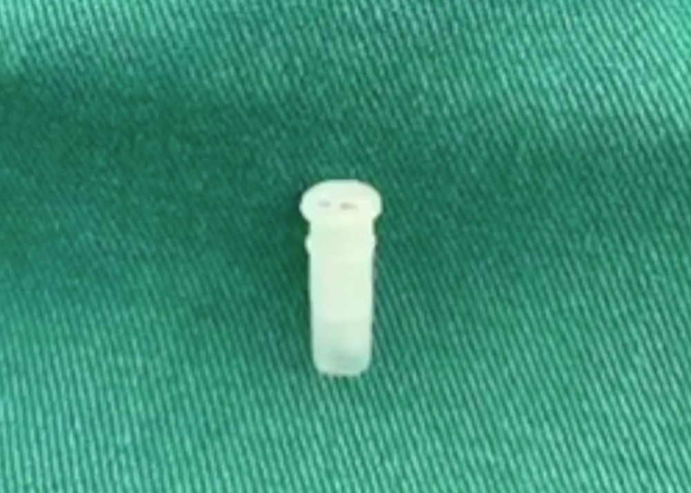 一名6歲女童用口含著弟弟鞋子上的塑膠哨子,不小心突然把哨子吞下,更發出「海豚音」。