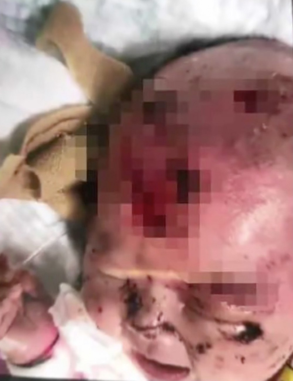 內地一名3個月大女嬰睡覺時，疑被老鼠咬傷。