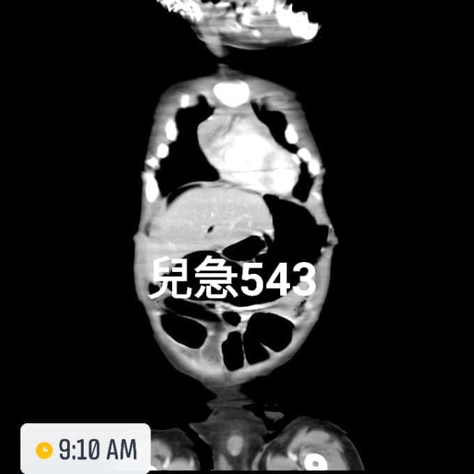 今天上班接的第一個病人,小孩的腸子破掉!