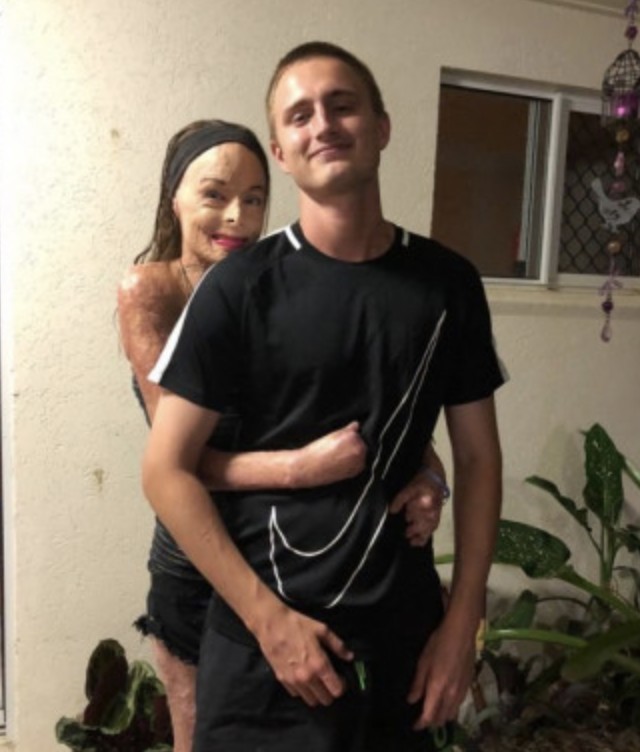 53歲澳洲媽媽Carol Mayer,20年前為救兒子脫離火海,全身皮膚燒傷達85%。