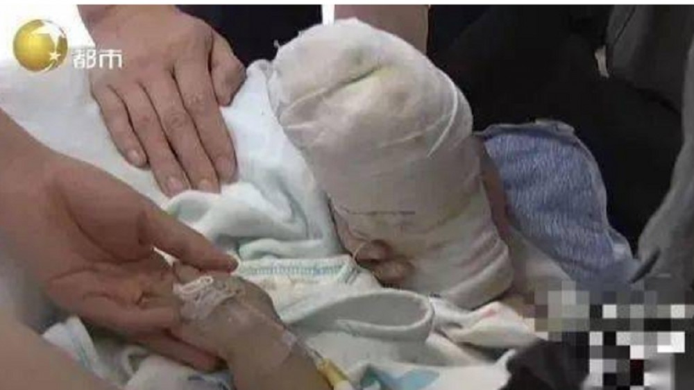 樂樂（化名）的右手嚴重燙傷。