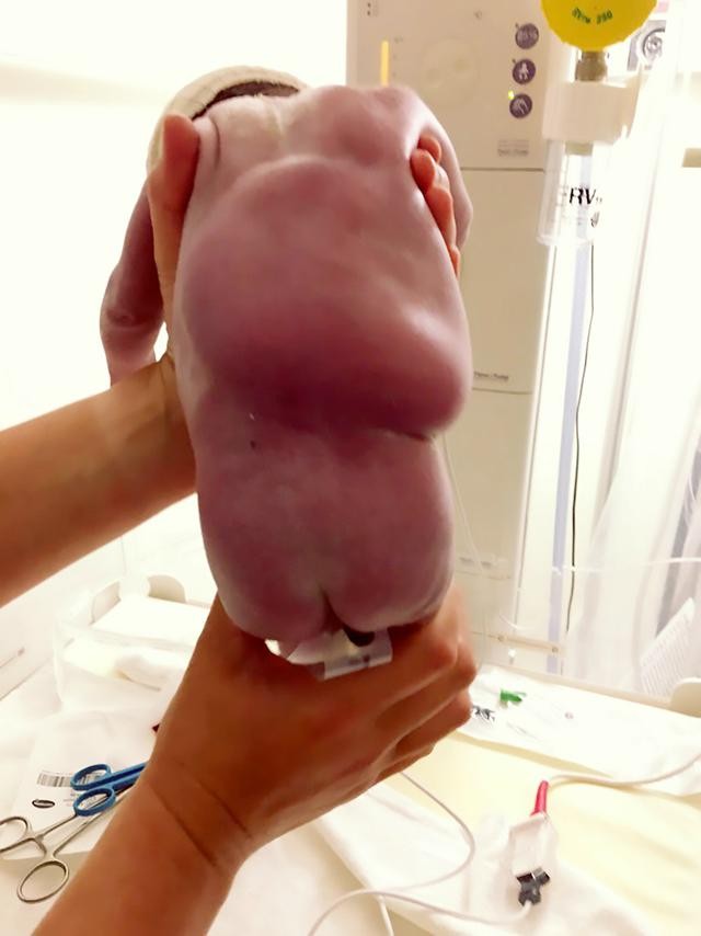BB腫起的背脊出生後幾小時已消去。