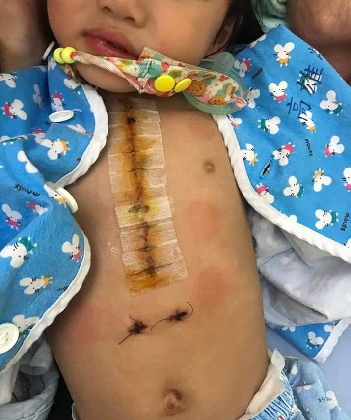 小女兒不到兩歲已開刀兩次。