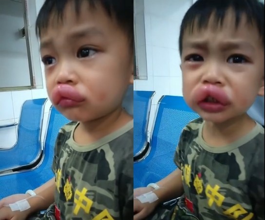 廣西1名4歲男童吃了自家的葡萄之後,上嘴脣瞬間變膶腸嘴。
