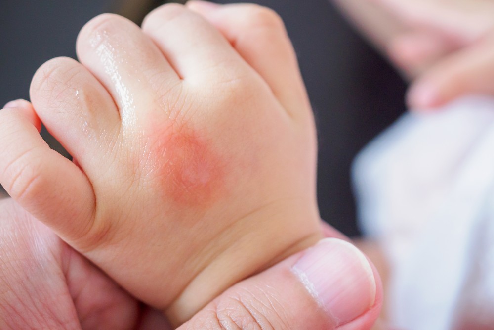 baby bite by bed bugs.