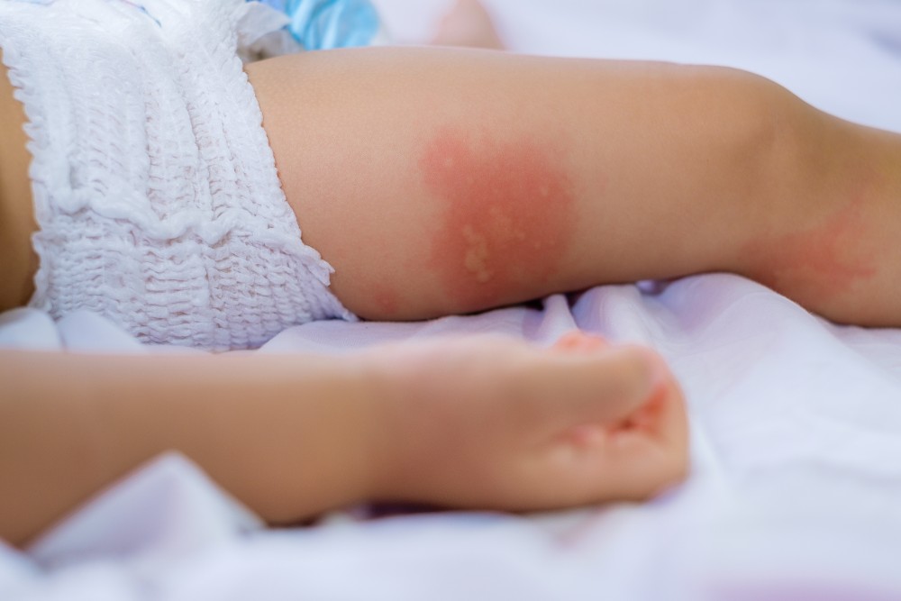 food allergy baby.