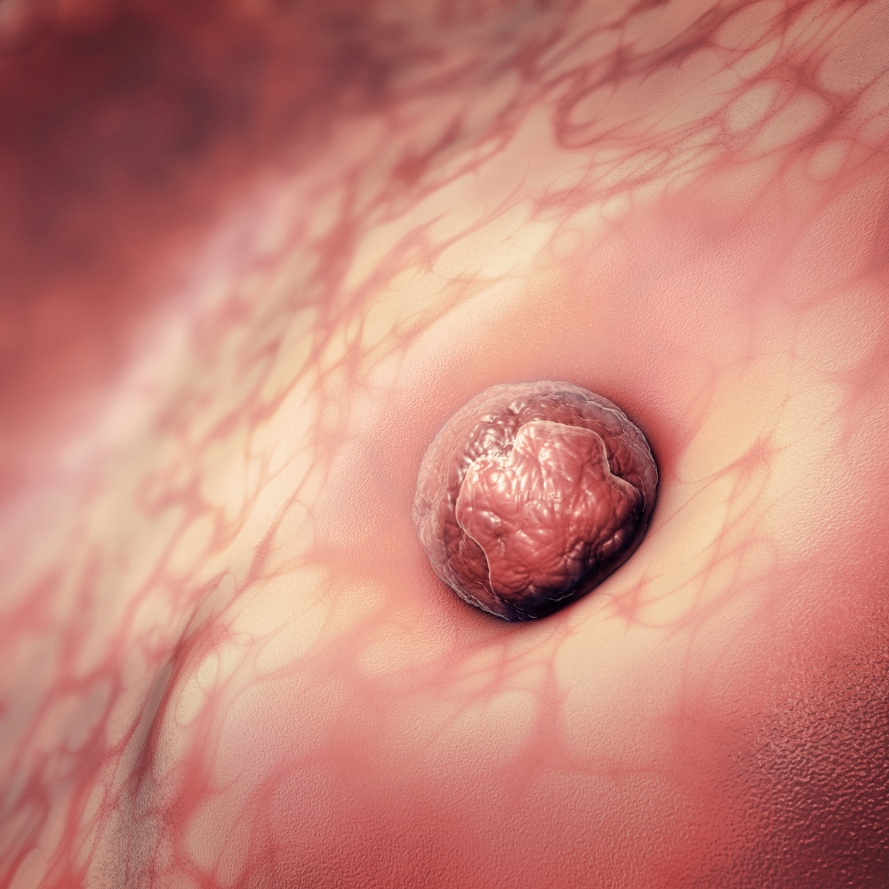 胚胎著床可造成陰道出血