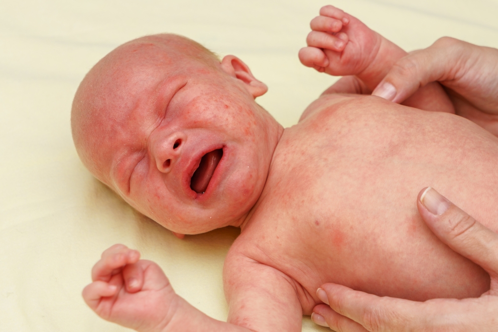 奶蘚既是小兒濕疹,常發病於幼兒