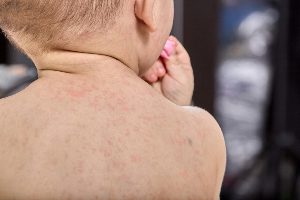 Roseola