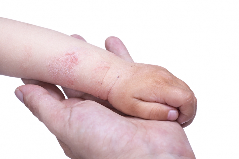 濕疹(Eczema)是皮膚炎症的統稱,其中包括異位性皮膚炎、脂漏性皮膚炎、缺脂性乾癢、富貴手等。