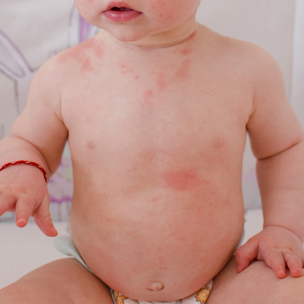 玫瑰疹（Roseola infantum）是由病毒引起的常見疾病。