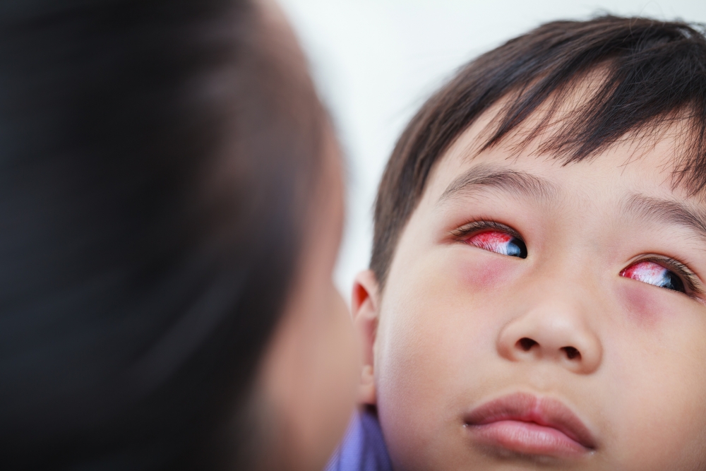 儿童健康】10个向眼科求诊1人患红眼症常捽眼最易受感染| MamiDaily 亲子日常