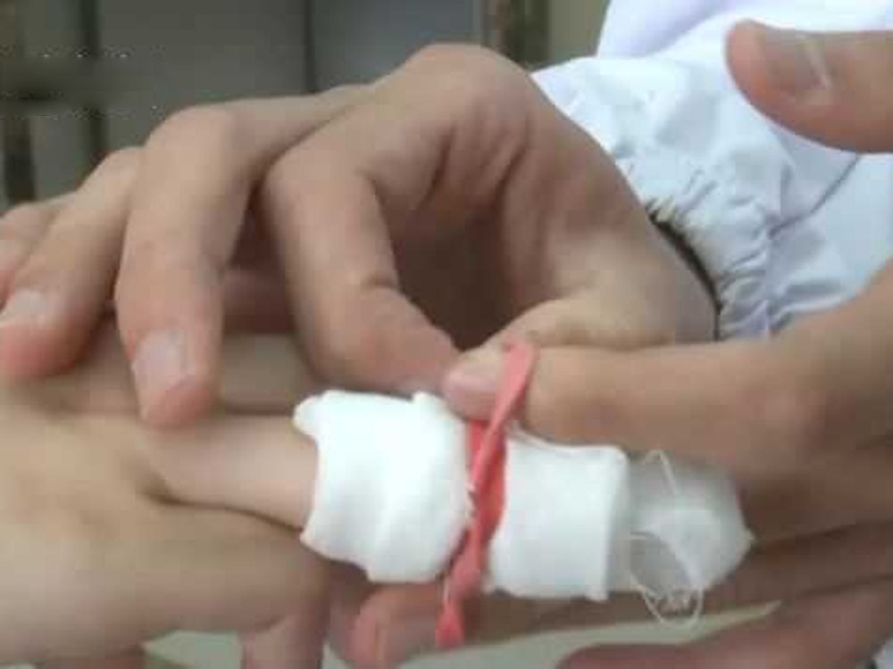 用橡筋包紥傷口