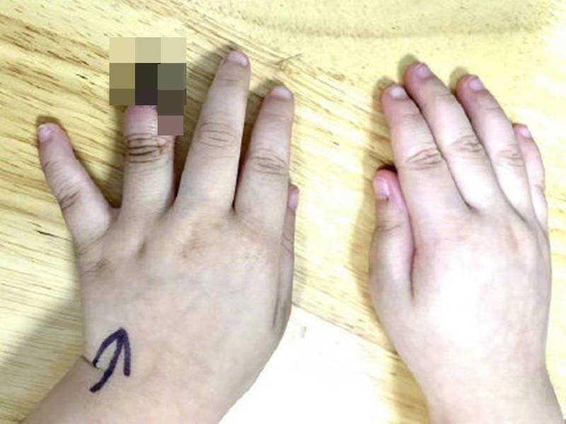 驚見原本包紥的手指腫脹發黑,逐立即慌忙再送女童入院。