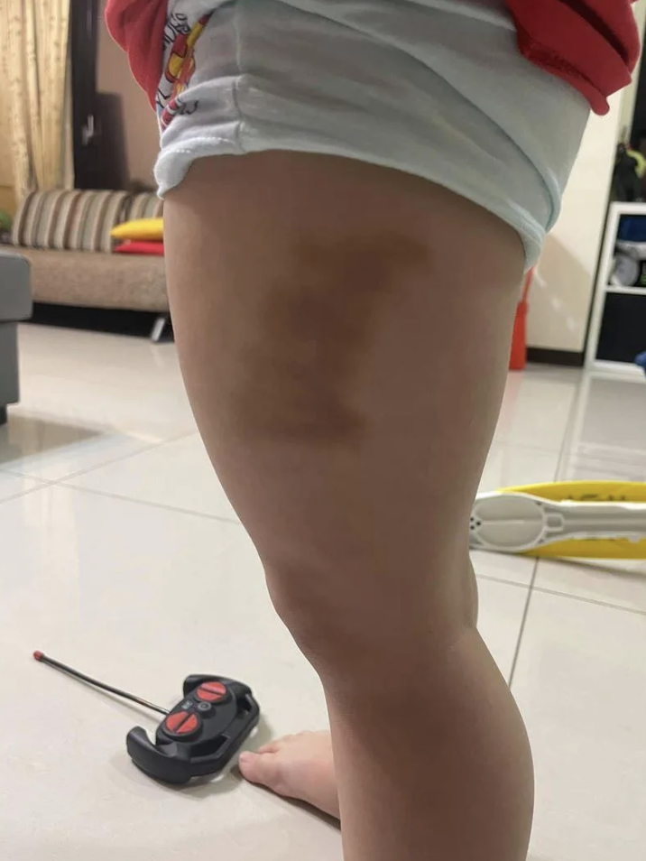 媽媽指3歲的兒子放學後大腿出現了大面積的瘀青,但學校卻表示孩子並無受傷或被老師責罰。