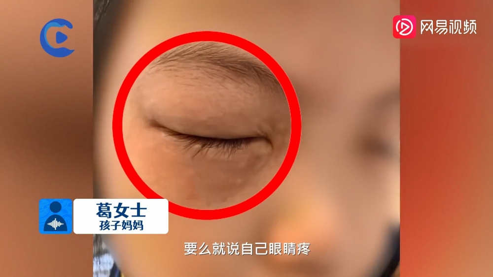 內地一名9歲女童在今年開學後,發現每次做數學功課都會出現眼睛過敏。