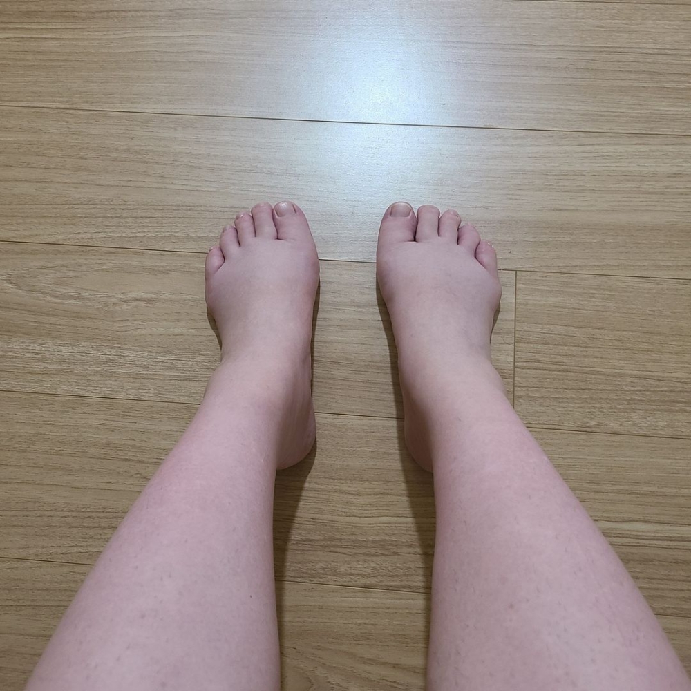 黃信英有嚴重腳腫,目前老公每天都會用輪椅推著她走