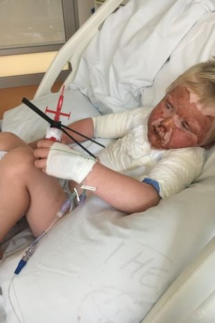 Oscar被火苗吞噬，被燒成人型火球。