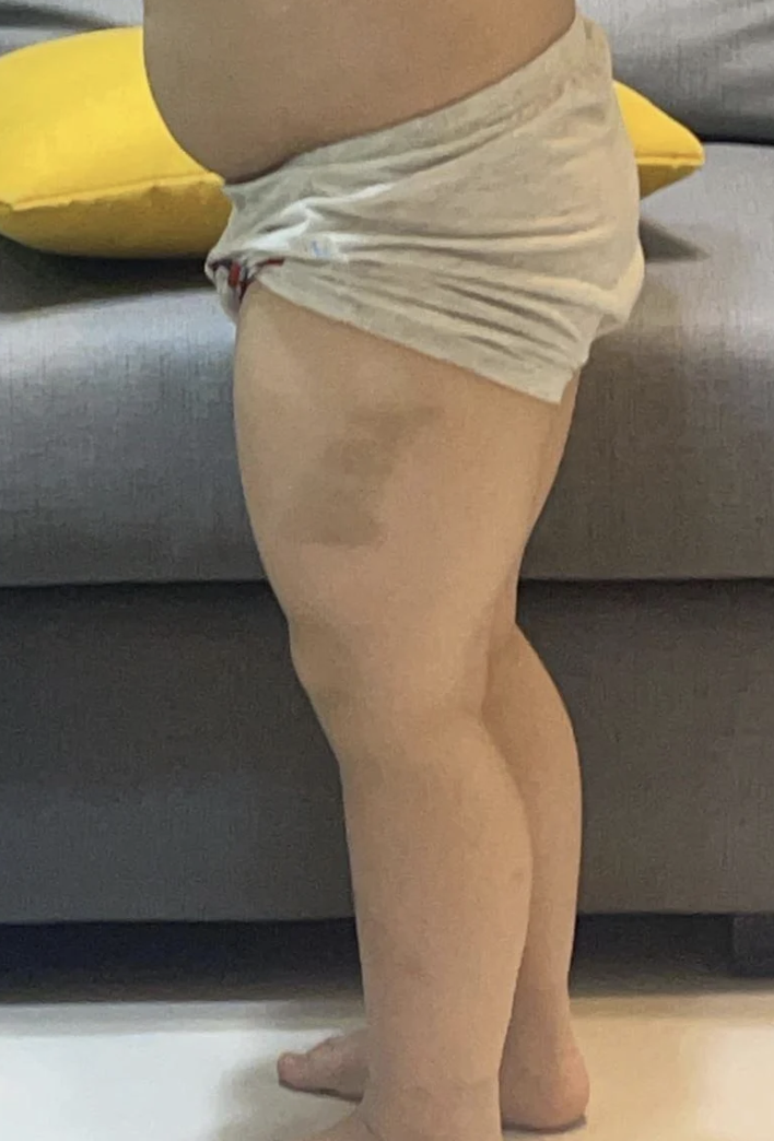 台灣有位3歲男孩在放學回家一段時間後,大腿外側出現一大片瘀青。