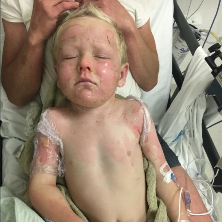 不需要接受植皮手術，留院一星期便可回家。