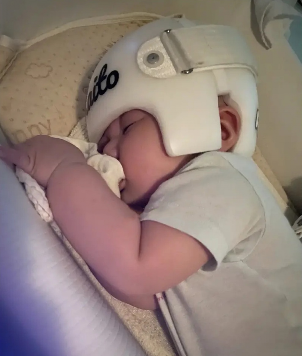 嬰兒佩戴頭盔整體來說不會造成疼痛感，不過每天需要最少佩戴23小時。