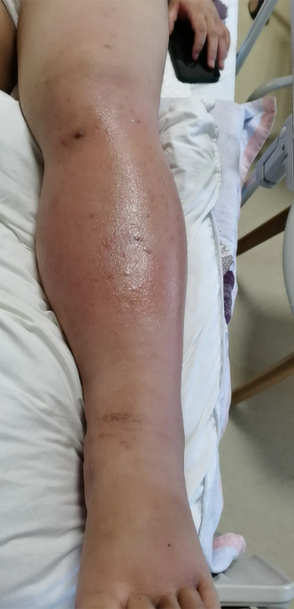 中國杭州一名孕婦,被蚊子叮咬勁引致丹毒,左下肢嚴重腫脹。