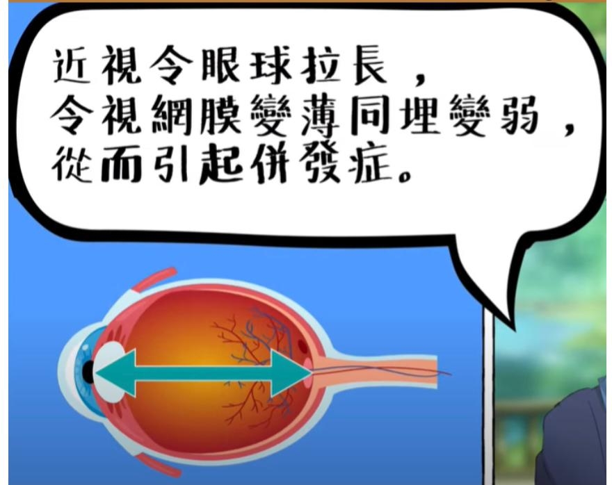 深近視患者的眼球被拉長了,周邊的視網膜變薄,會增加視網膜脫落和黃斑點病變的風險。
