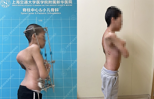 內地一名女大學生患神經纖維瘤病11年,脊柱嚴重側彎。