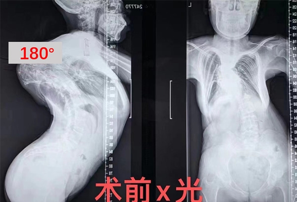 經過7個小時的手術,女大學生得以重新站立。