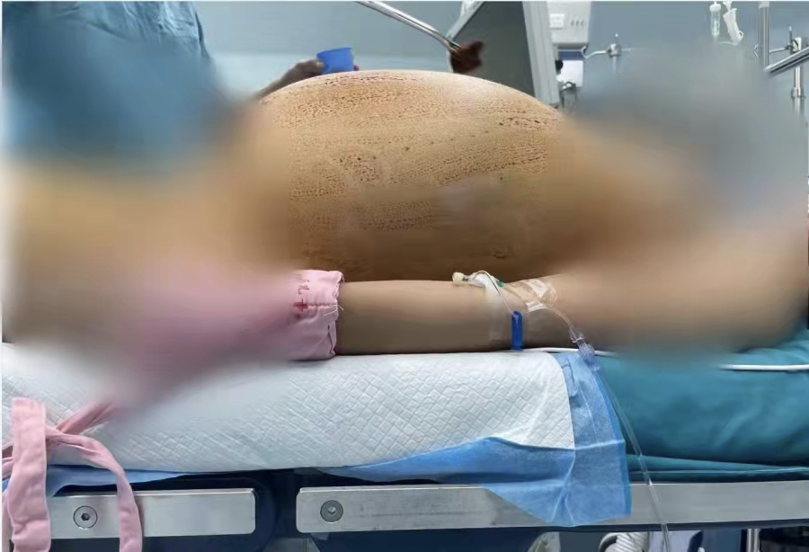 深圳13歲女童腹脹如孕婦。