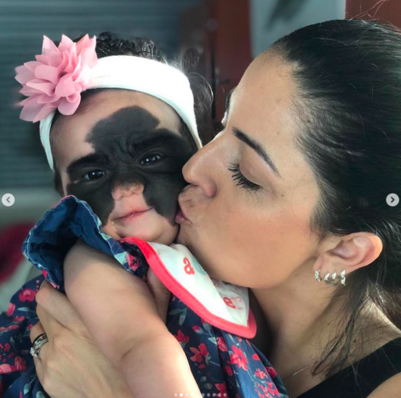 美國一名2歲女童天生臉上長有一片面積很大的黑色胎記。