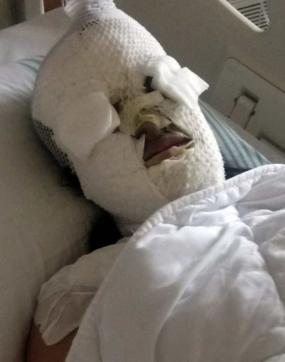 男友把腐蝕性液體潑向女生的臉上,導致她的臉部嚴重毁容及其中一隻眼僅剩三成視力。