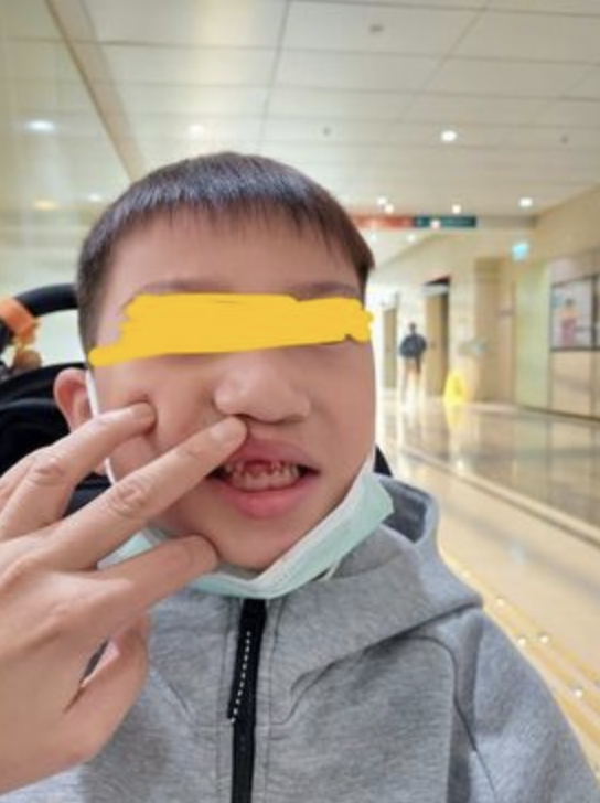 受驚的大仔未知是否因意外而神不守舍,在送院途中更不小心跌倒以致門牙脫落。