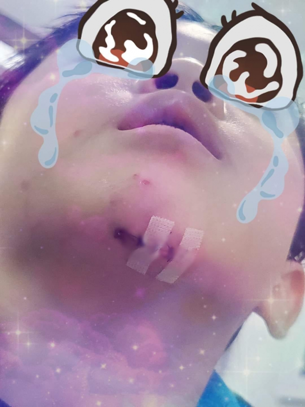 小朋友在泳池跌倒弄傷下巴。