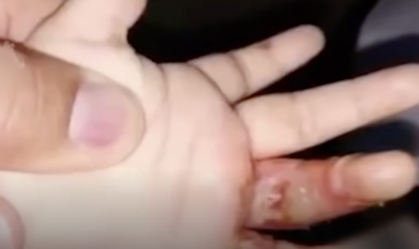 河南鄭州有一位嫲嫲誤信民間療法，竟用老鼠製成的偏方「老鼠熬油」治理孫仔的燙傷。