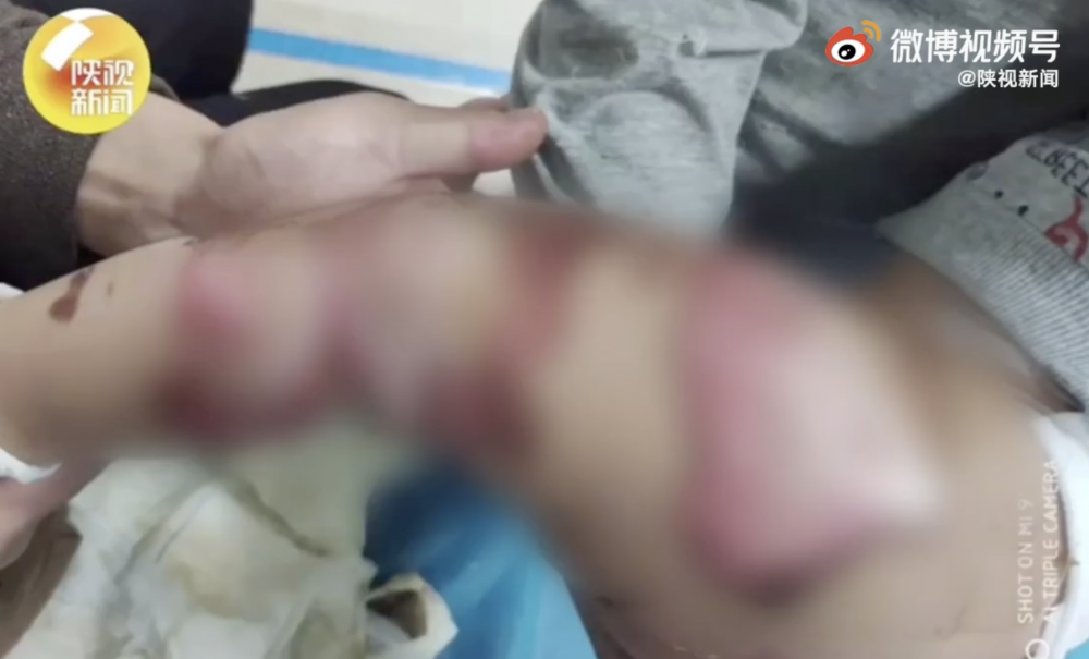男孩因尿床導致電熱氈漏電,腳和背部被燒傷。