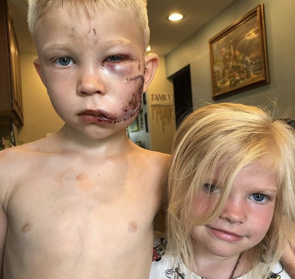 現年7歲的Bridger曾經從惡犬口中勇救妹妹，被咬至重傷的他事後足足縫了90針。