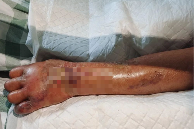 老翁被蝦刺傷後引發傷口感染,導致壞死性筋膜炎。