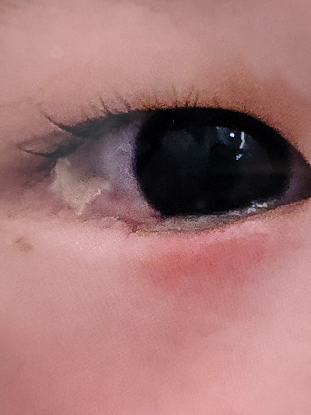 兒子眼睛出現發炎,和大量分泌物。