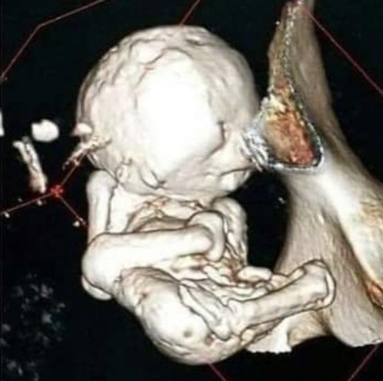 石胎已經有7個月胎齡,重達2公斤。