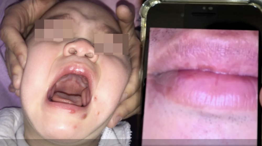 醫生推論將疱疹病毒傳染給小BB的正是他們的父親。