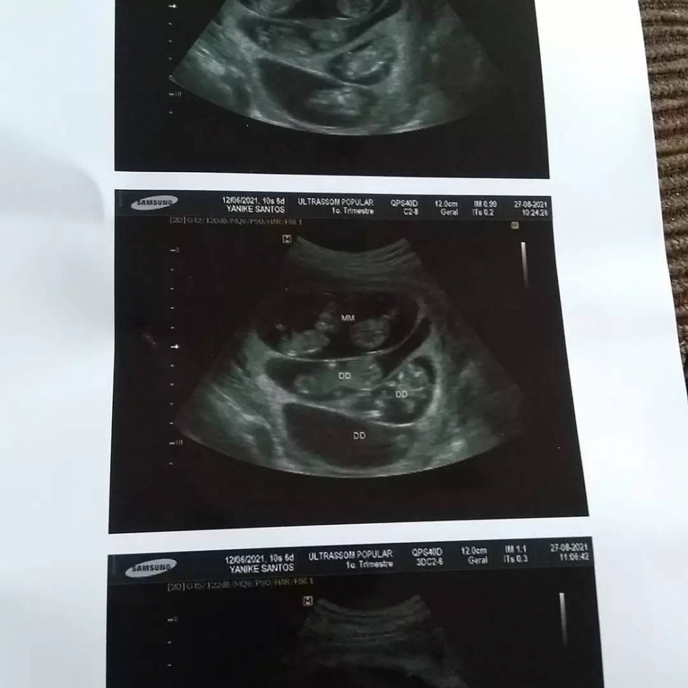 五個胎兒清晰可見。