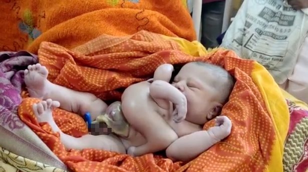 印度一嬰兒天生擁有4隻手4隻腳，受到民眾膜拜。