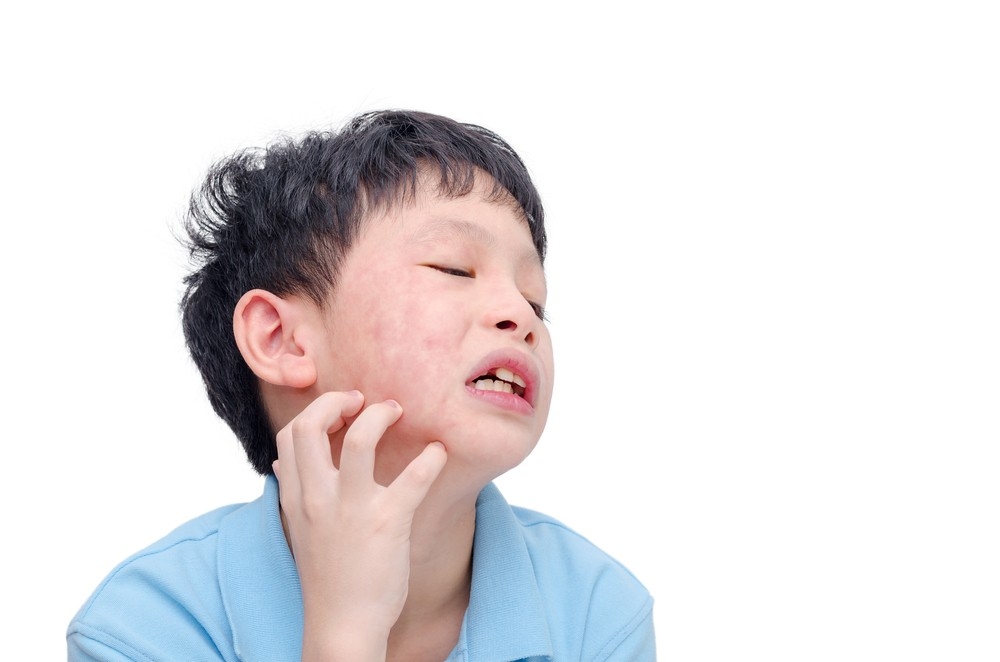 英國醫生指出，15% Omicron兒童或青少年確症患者長出皮疹。
