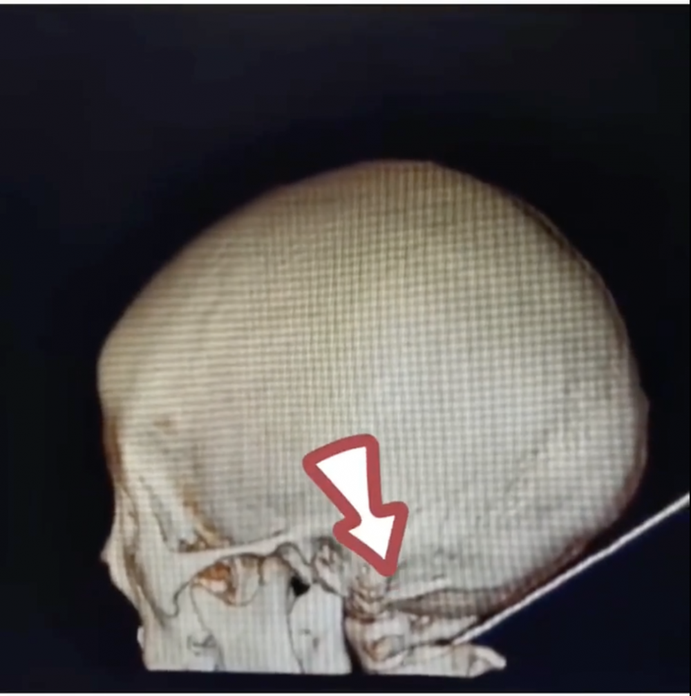 X光檢查顯示鉛筆由枕部斜穿到右側頸部。