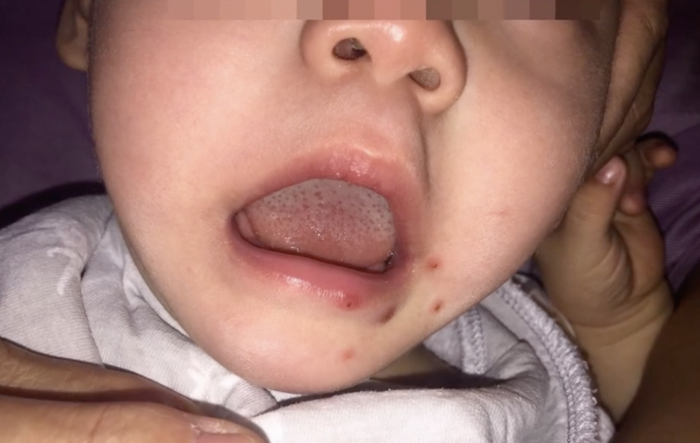 男嬰口腔內部潰爛、牙齦紅腫出血，下嘴唇周圍也有明顯的水泡，經過醫生診斷後，確診為「疱疹性齒齦舌炎」。