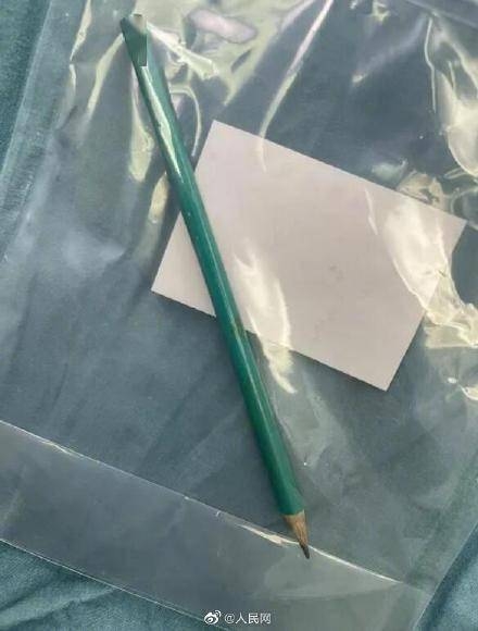 尖銳的鉛筆成功被取出,男童也已經痊癒出院。